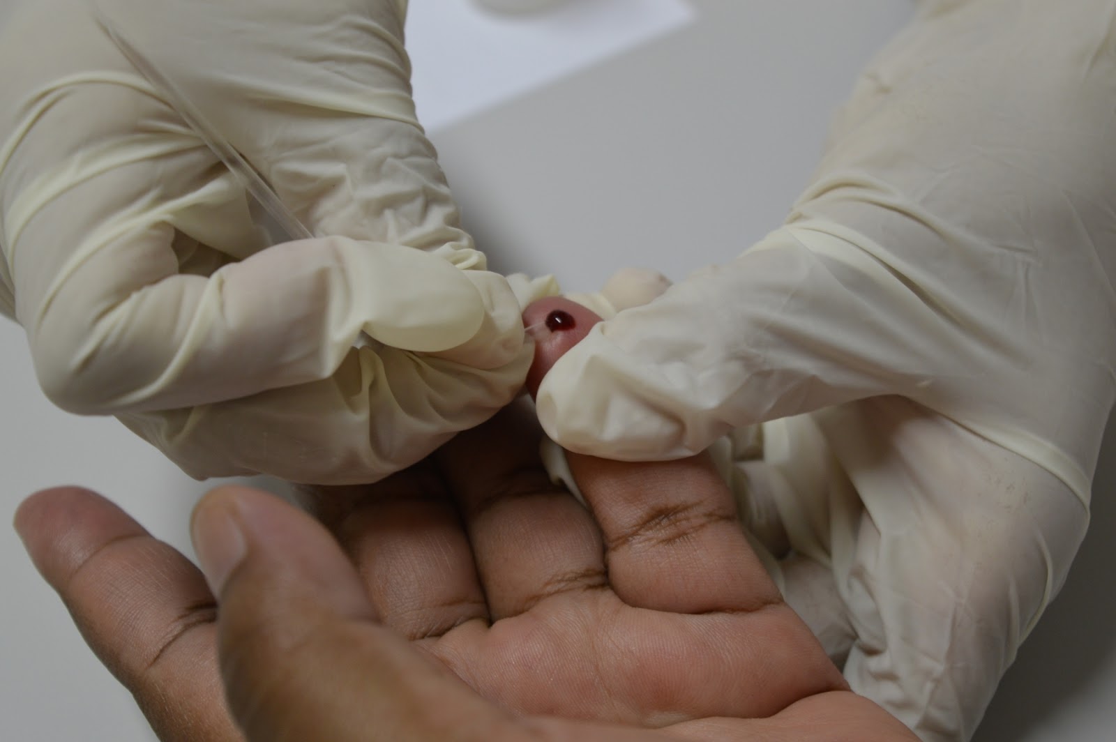 Programa de combate a IST/AIDs  promove testagem rápida em Queimados